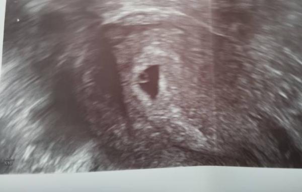 Bild zu SSW 7+2 kein Herzschlag unveränderter Ultraschall - Forum für Januar - Mamis