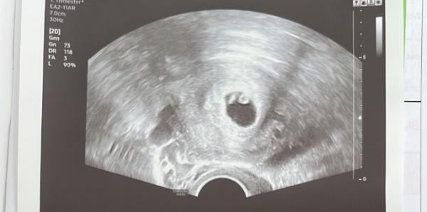 Bild zu Ultraschall - Forum für Januar - Mamis