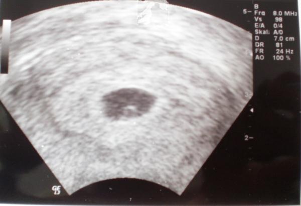 Bild zu Erstes Ultraschallbild :-)))))))))))) - Forum für Februar - Mamis