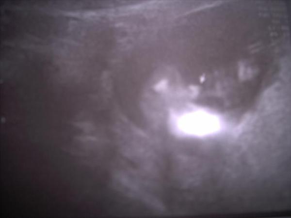 Bild zu Komme grad vom Arzt, und erste Prognose was es wird .. - Forum für Februar - Mamis