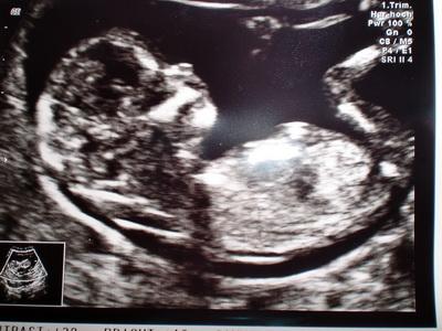 Bild zu Feinultraschall - Forum für Februar - Mamis