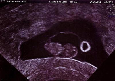 Bild zu Ultraschall 8.Woche - Forum für Februar - Mamis