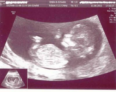 Bild zu NT Messung, neues Foto & 3D Miniouting - Forum für Februar - Mamis