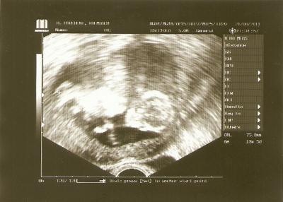 Bild zu Schmerzen links + Bild von heute - Forum für Februar - Mamis