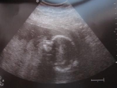 Bild zu Guten morgen VU und 2.Screening hinter uns - Forum für Februar - Mamis