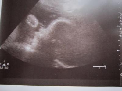 Bild zu Zurück von VU und 3.Screening - Forum für Februar - Mamis