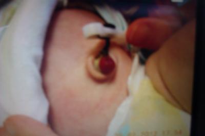 Bild zu ich zeig mal weswegen mein fynn operiert wird - Forum für Februar - Mamis