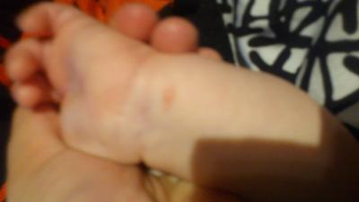 Bild zu flecken am Körper - Forum für Februar - Mamis