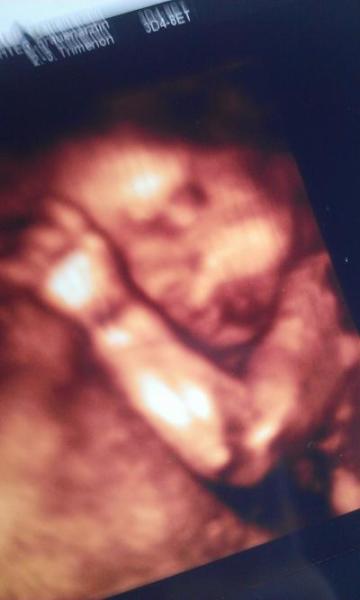 Bild zu Wehwehchen und 3D Bild - Forum für Februar - Mamis