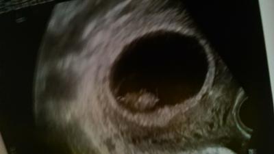 Bild zu Fruchthöhle eine Woche weiter - Forum für Februar - Mamis