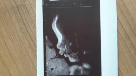 Bild zu Neu hier und Mädchen mit botoxlippe? - Forum für Februar - Mamis
