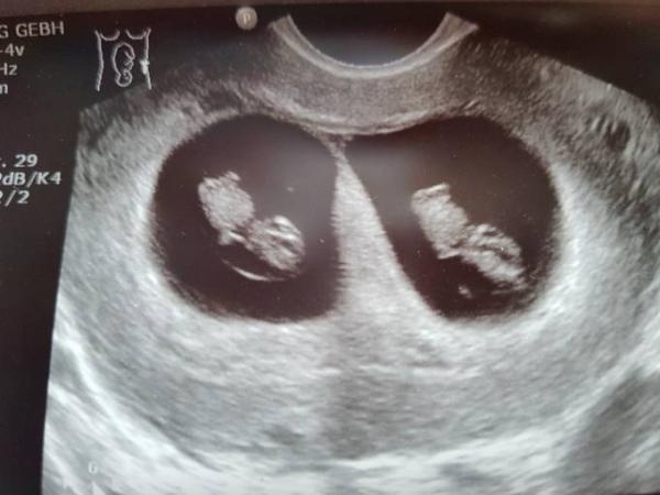 Bild zu Aua aua aua - Forum für Februar - Mamis