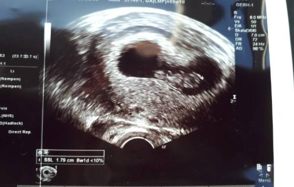 Bild zu Hämatom, Blutungen, Embryo zu klein, SS Anzeichen - Forum für Februar - Mamis