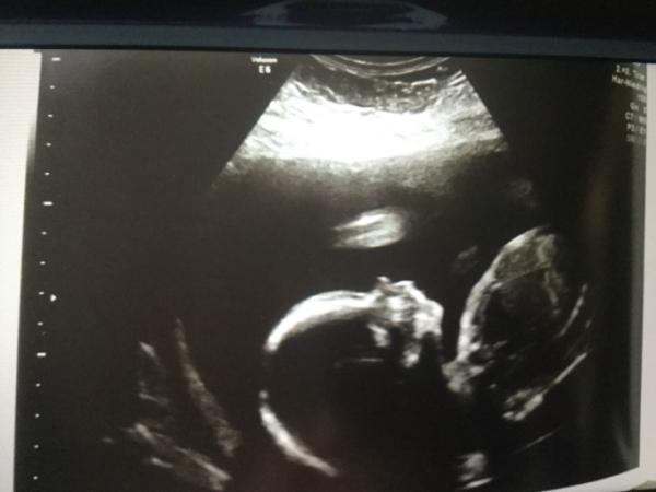 Bild zu Wir sind auch zurück vom Organscreening  - Forum für Februar - Mamis