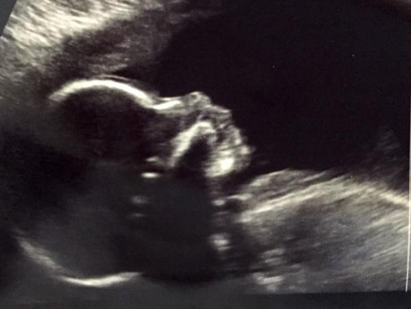 Bild zu Gestern großer Organ-Ultraschall - Forum für Februar - Mamis