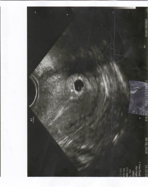 Bild zu Ultraschallbild - Forum für Februar - Mamis