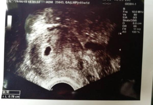 Bild zu Fruchthöhle und Dottersack - Forum für Februar - Mamis