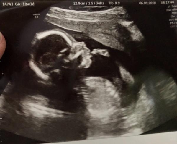 Bild zu 2. großer Ultraschall, Organscreening - Forum für Februar - Mamis