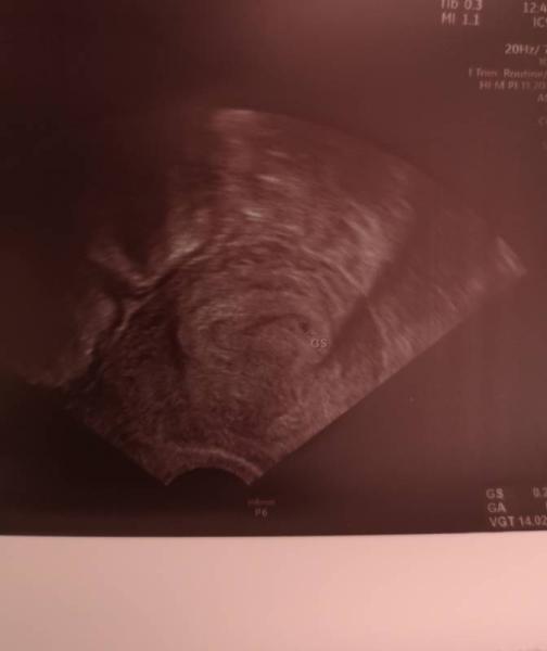 Bild zu Ultraschall - Forum für Februar - Mamis