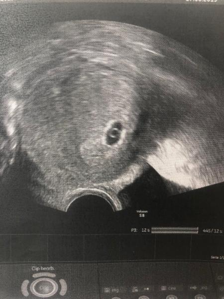 Bild zu 5+5 nur Dottersack zu sehen? - Forum für Februar - Mamis