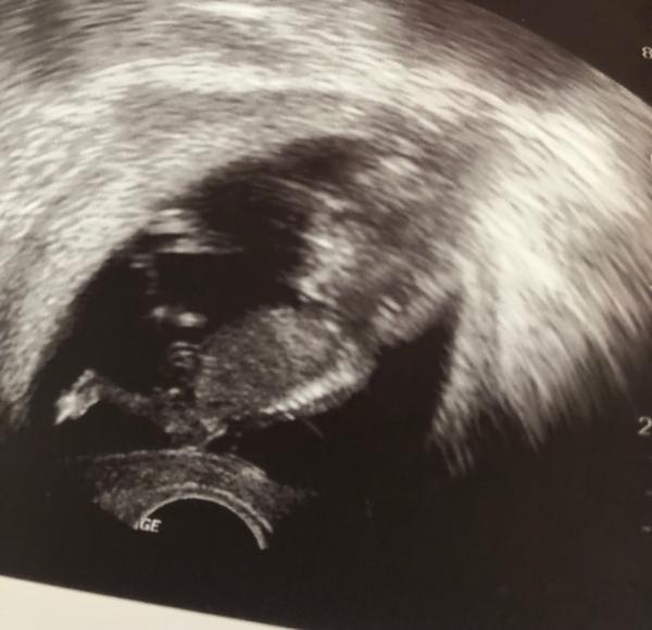 Bild zu Ultraschall Mädchen oder Junge? - Forum für Februar - Mamis