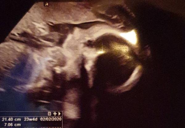 Bild zu US in 23. Ssw und etwas schockiert.... - Forum für Februar - Mamis