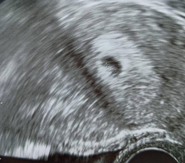 Bild zu Erster FA - Ultraschall 5+1 - Forum für Februar - Mamis