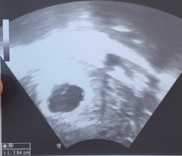 Bild zu Ultraschallbild SSW 6 oder 7 - Forum für Februar - Mamis