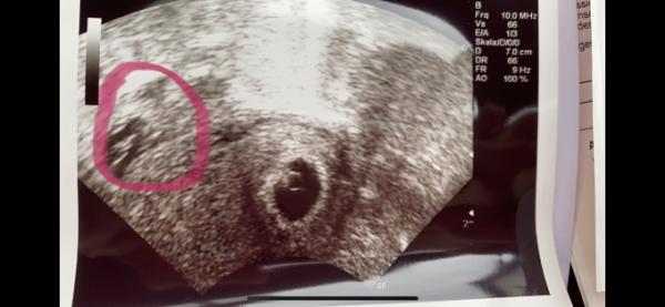Bild zu Mir ist was in meinem Ultraschall aufgefallen... Was meint Ihr? - Forum für Februar - Mamis