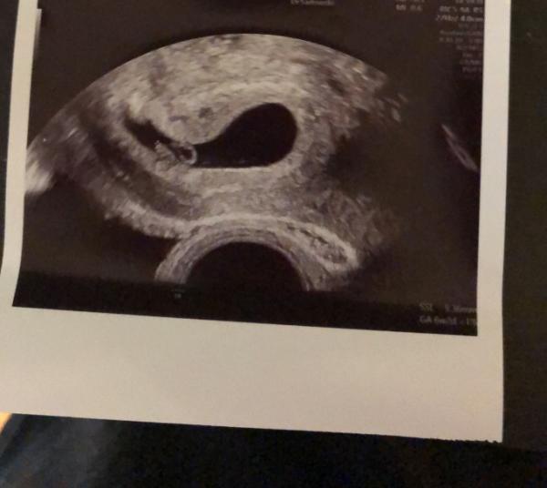 Bild zu Ultraschallbild - Forum für Februar - Mamis