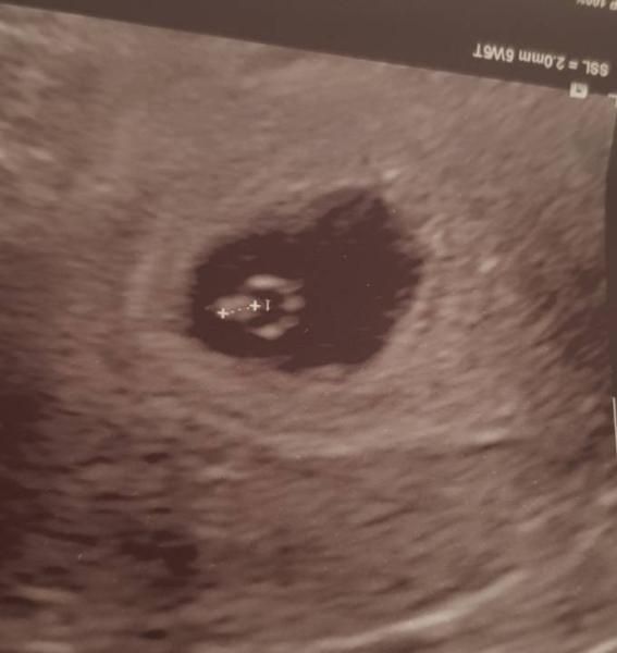 Bild zu Erster Ultraschall - Forum für Februar - Mamis