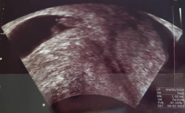Bild zu Hallo Krümel ~ Erster Ultraschall - Forum für Februar - Mamis