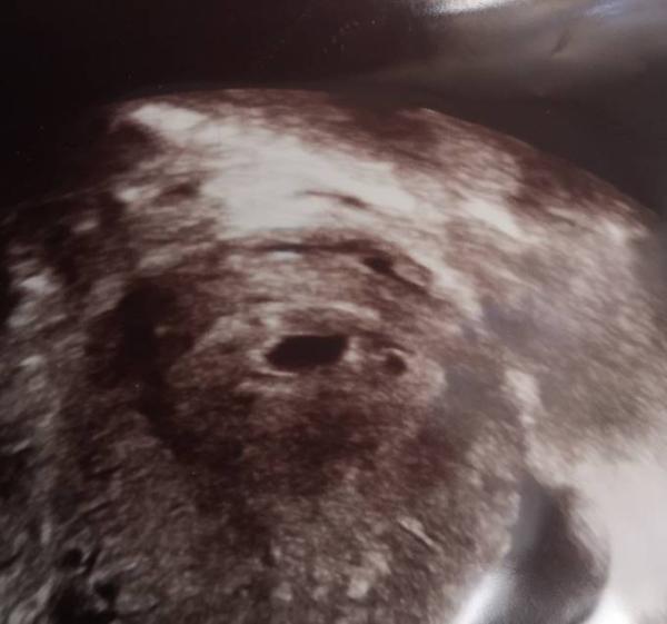 Bild zu Sind das zwei Fruchthöhlen? 4+5 - Forum für Februar - Mamis