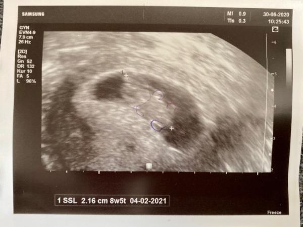 Bild zu FA Termin - Baby sieht aus wie ein teddybär - Forum für Februar - Mamis