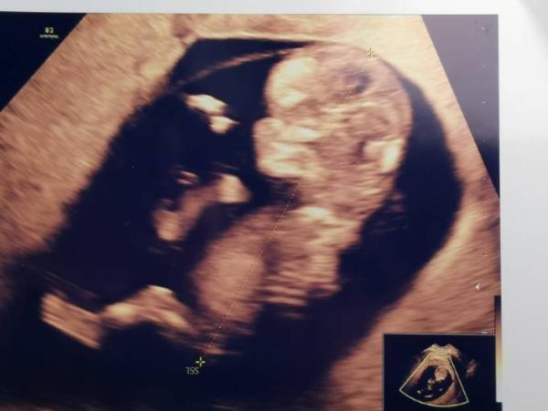 Bild zu Gyn Termin heute bei 11+1 mit Foto... - Forum für Februar - Mamis