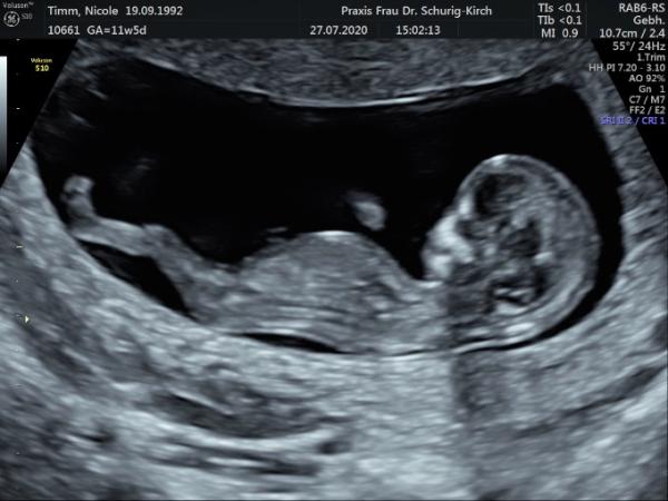 Bild zu 1. Grosses Ultraschall Screening - Forum für Februar - Mamis
