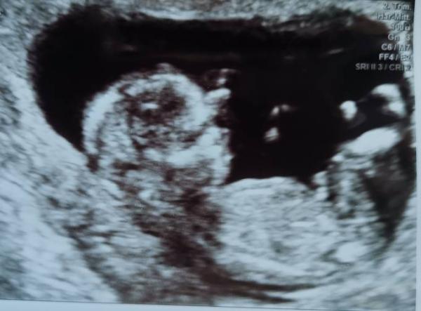 Bild zu NFM + Praenatest - Forum für Februar - Mamis