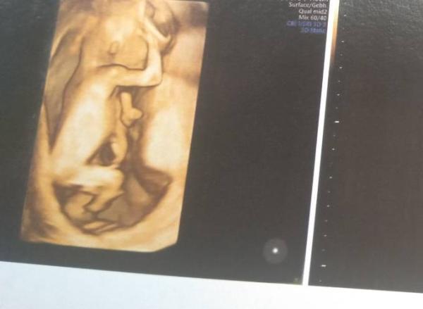 Bild zu Ersttrimester-Screening - Forum für Februar - Mamis