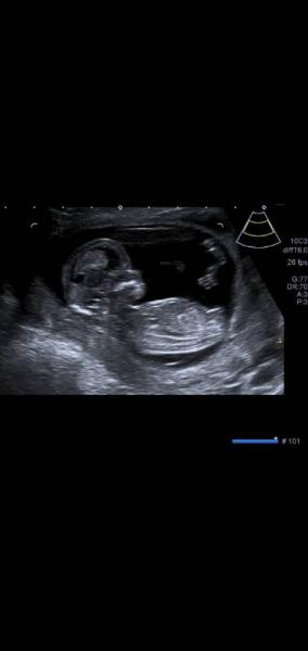 Bild zu Mädchen oder Junge - 12+0 ssw - Forum für Februar - Mamis