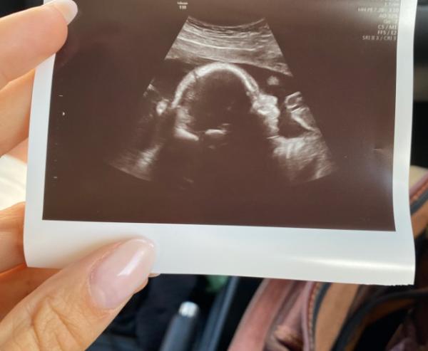 Bild zu Organscreening ja oder nein? - Forum für Februar - Mamis