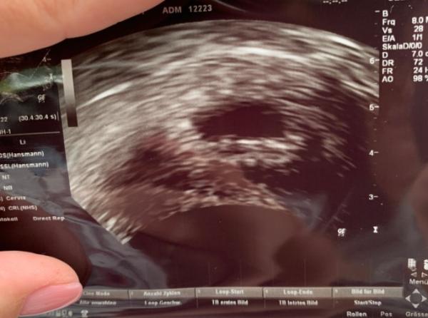 Bild zu 8-+0 3. termin - Forum für Februar - Mamis