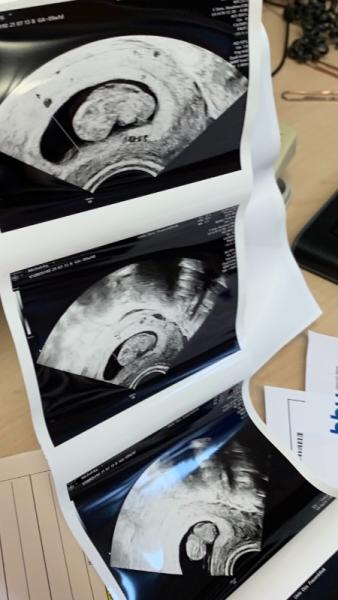 Bild zu Missed abord 10. ssw 9+1 - Forum für Februar - Mamis