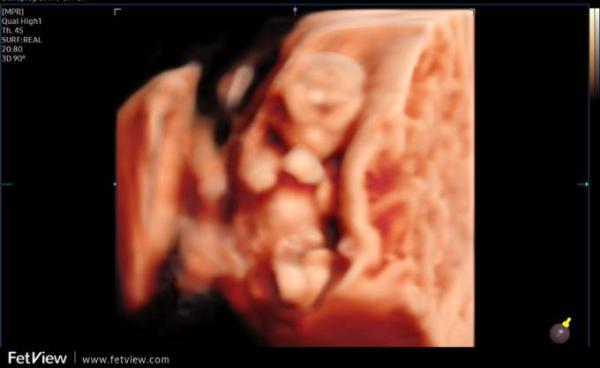 Bild zu Heute Ersttrimester Screening - Forum für Februar - Mamis