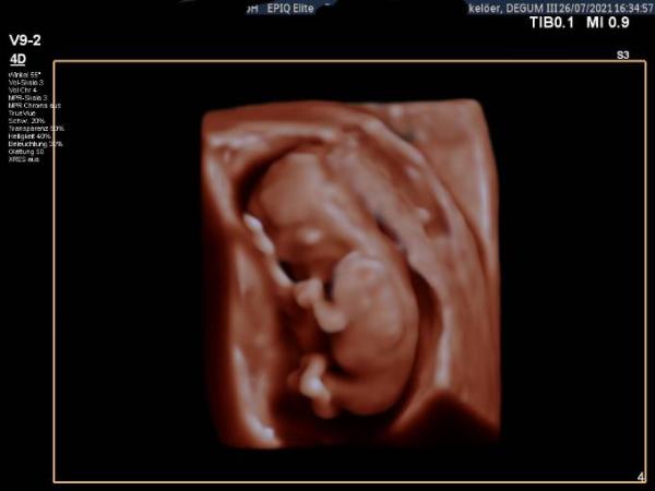 Bild zu Auch wir waren heute beim Erst-Trimester-Screening - Forum für Februar - Mamis