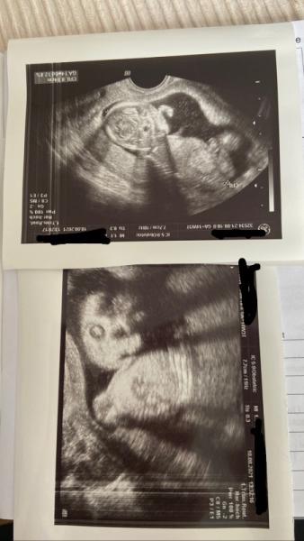 Bild zu Ultraschall Selfie 😂 - Forum für Februar - Mamis