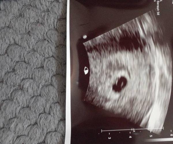 Bild zu Ultraschall - Forum für Februar - Mamis