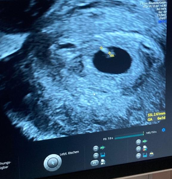 Bild zu 6+1 Embryo da und 6+5 leere fruchthülle - Forum für Februar - Mamis