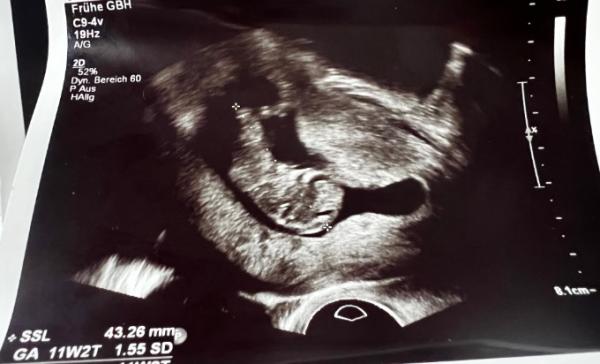 Bild zu 10+5 Ultraschallbild komisch? - Forum für Februar - Mamis