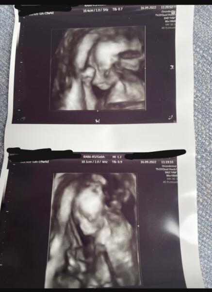 Bild zu Gruseliges 3D Ultraschallbild - Forum für Februar - Mamis
