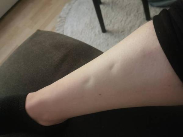 Bild zu Wassereinlagerungen - Forum für Februar - Mamis